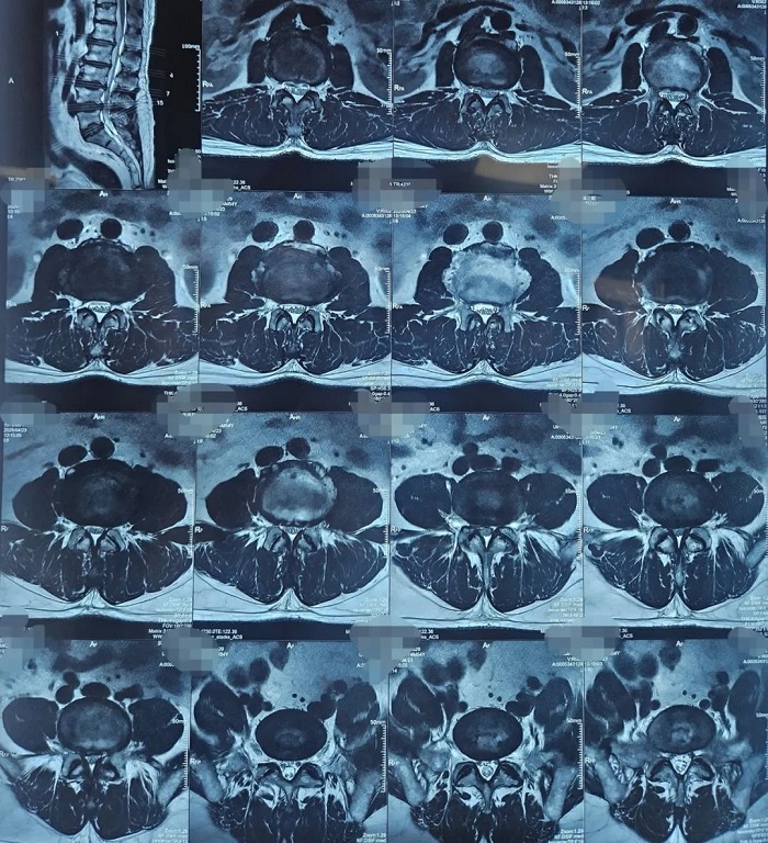 病例分享|洪洞县中医医院骨伤科完成一例UBE腰4/5内镜下右侧椎板减压经皮椎弓根钉内固定椎间隙植骨+可撑开融合器融合术