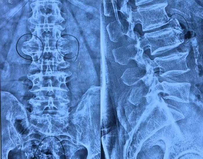 病例分享|洪洞县中医医院骨伤科完成一例UBE腰4/5内镜下右侧椎板减压经皮椎弓根钉内固定椎间隙植骨+可撑开融合器融合术