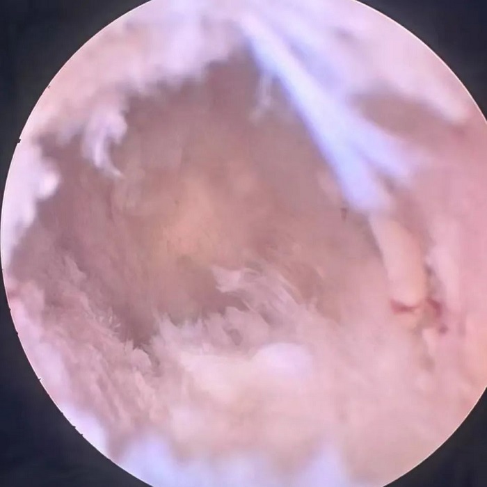 病例分享|洪洞县中医医院骨伤科完成一例UBE腰4/5内镜下右侧椎板减压经皮椎弓根钉内固定椎间隙植骨+可撑开融合器融合术