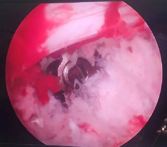 病例分享|洪洞县中医医院骨伤科完成一例UBE腰4/5内镜下右侧椎板减压经皮椎弓根钉内固定椎间隙植骨+可撑开融合器融合术