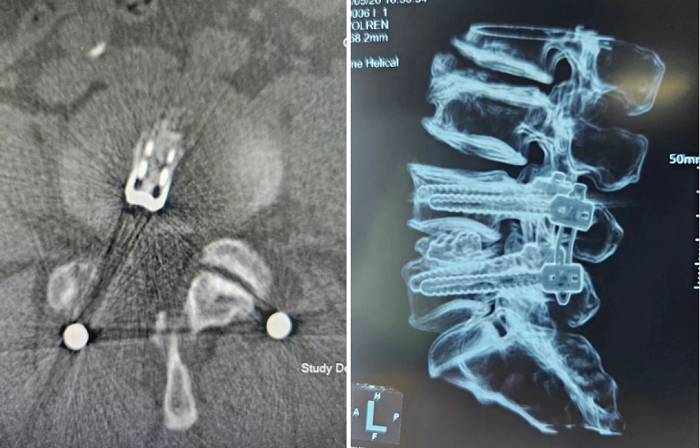 病例分享|洪洞县中医医院骨伤科完成一例UBE腰4/5内镜下右侧椎板减压经皮椎弓根钉内固定椎间隙植骨+可撑开融合器融合术